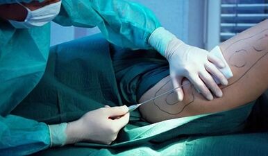 Chirurgie bariatrique